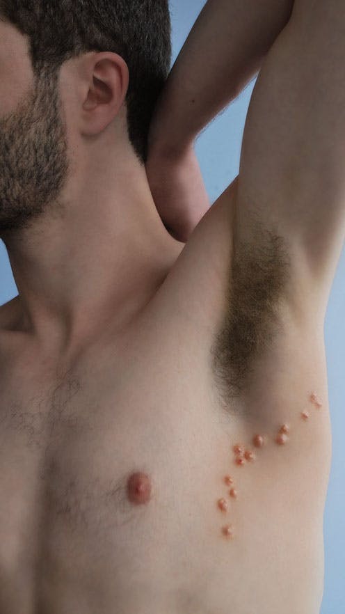 A man lifts his arm to reveal a collection of subdermal storage sites on the
side of his chest.